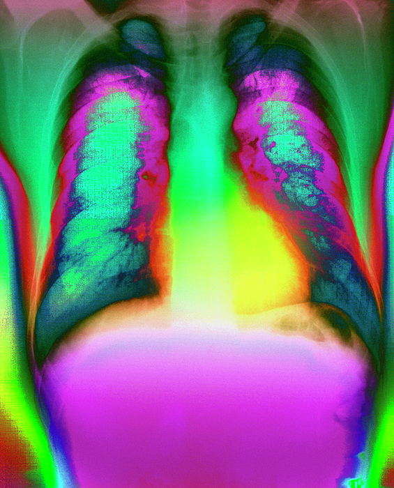 Coloured Chest X-ray Of A Healthy Man #3 Greeting Card by Mehau Kulyk ...
