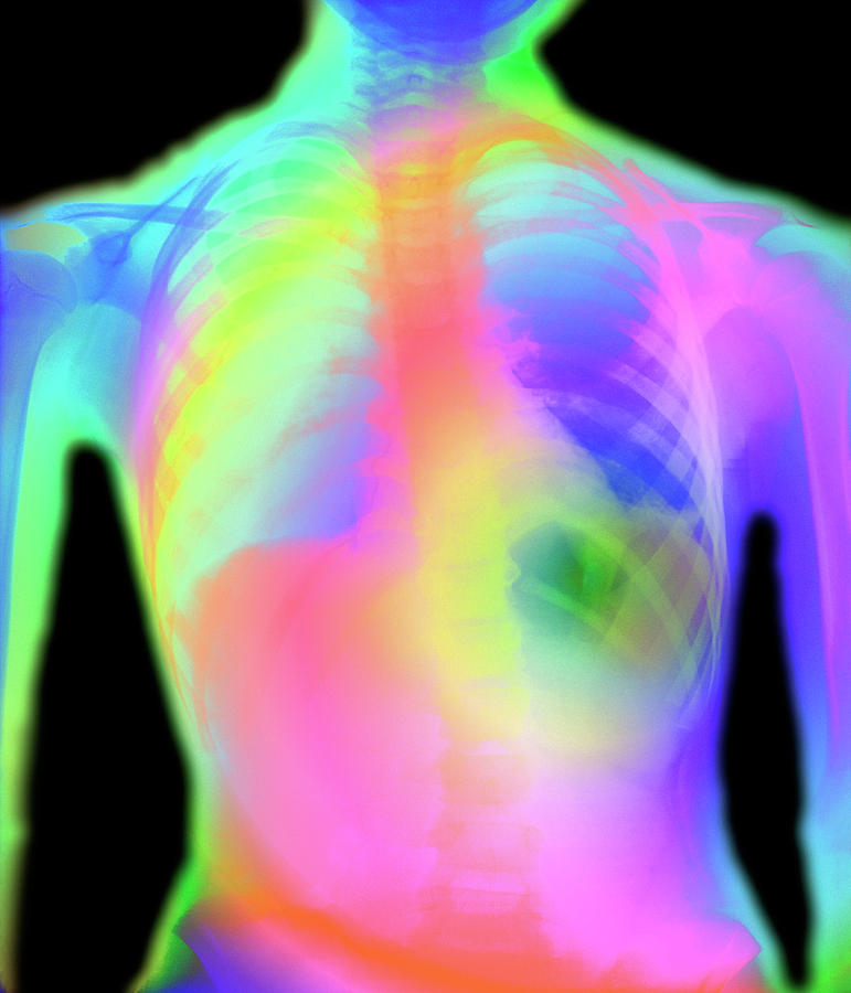 Coloured Chest X-ray Showing Pneumonia #1 by Mehau Kulyk / Science ...