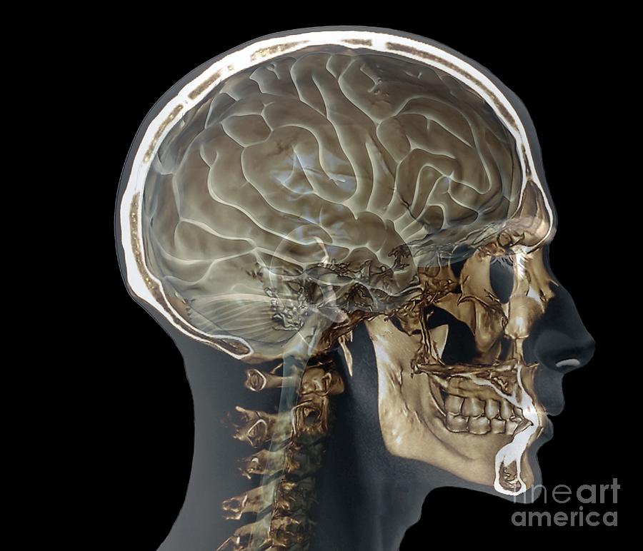 Normal Head And Neck, Mri And 3d Ct Scans #1 by Zephyr / Science