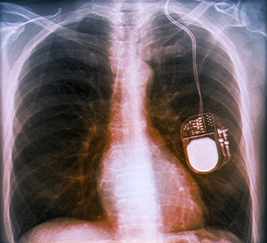Parkinson's Brain Pacemaker #1 by Zephyr / Science Photo Library