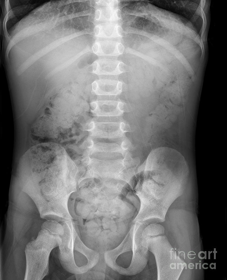 Swallowed Marble, X-ray #1 by Science Photo Library