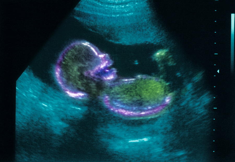 20 Week Foetus by Josh Sher / Science Photo Library