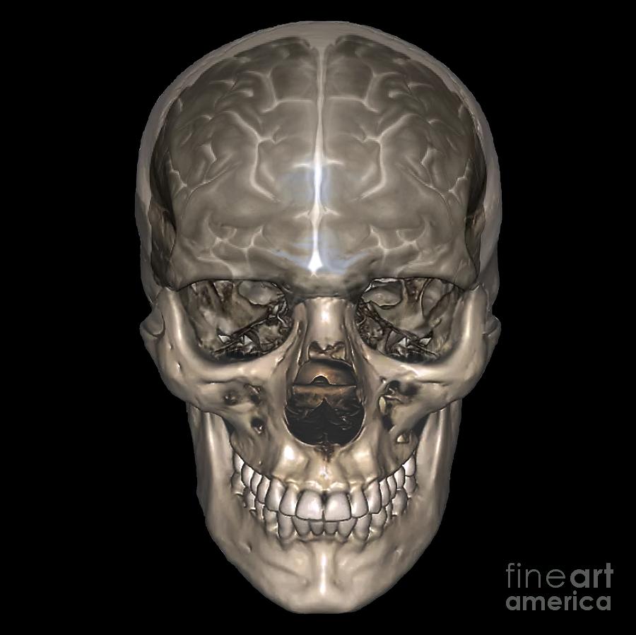 Human Head, Mri And 3d Ct Scans #5 by Zephyr / Science Photo Library