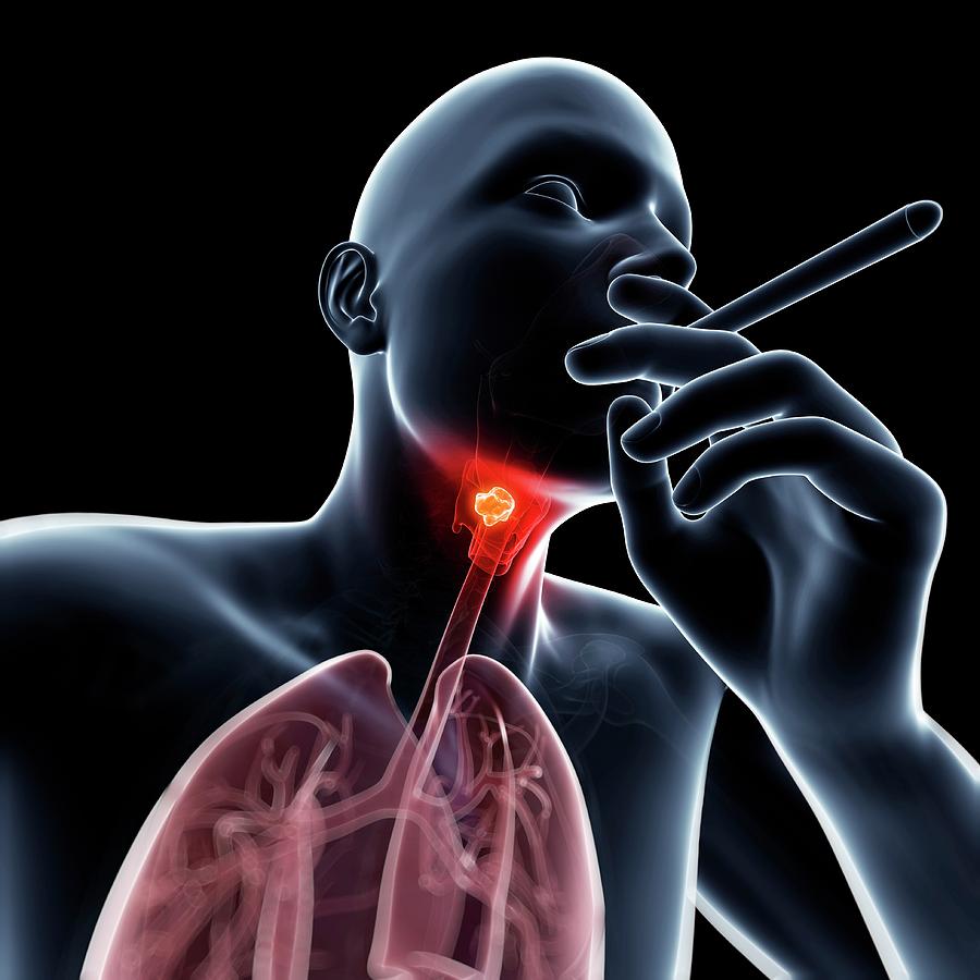 cigarette throat cancer Warning - Smoking causes Throat Cancer on the Rise