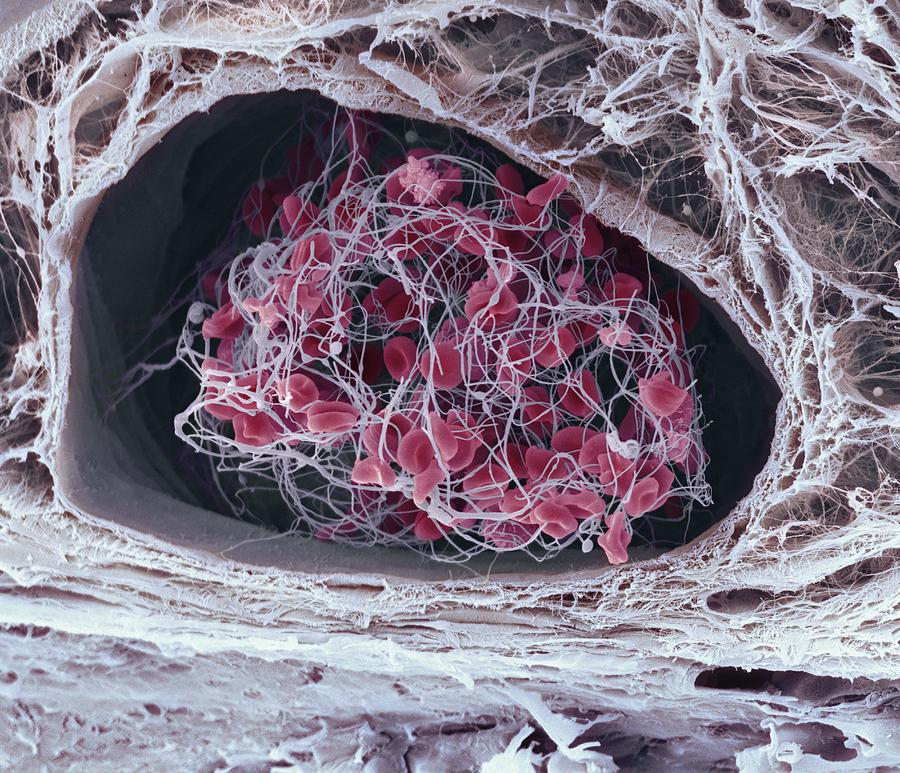 Blood clot by Steve Gschmeissner / Science Photo Library