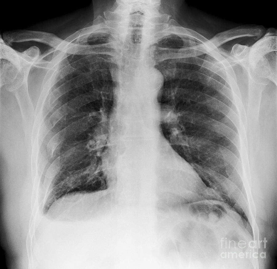Broken Ribs, X-ray by Science Photo Library