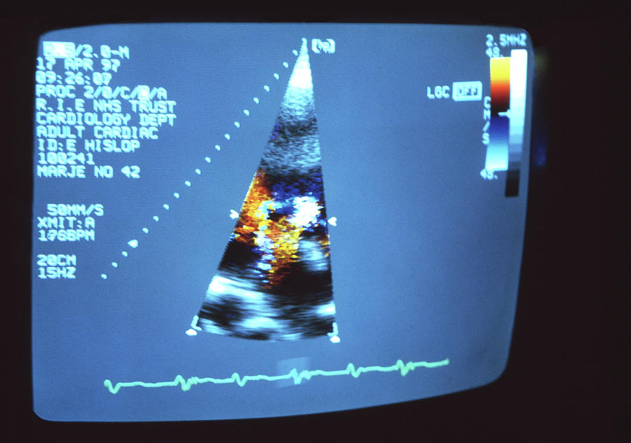 Heart Ultrasound Scan by Antonia Reeve / Science Photo Library