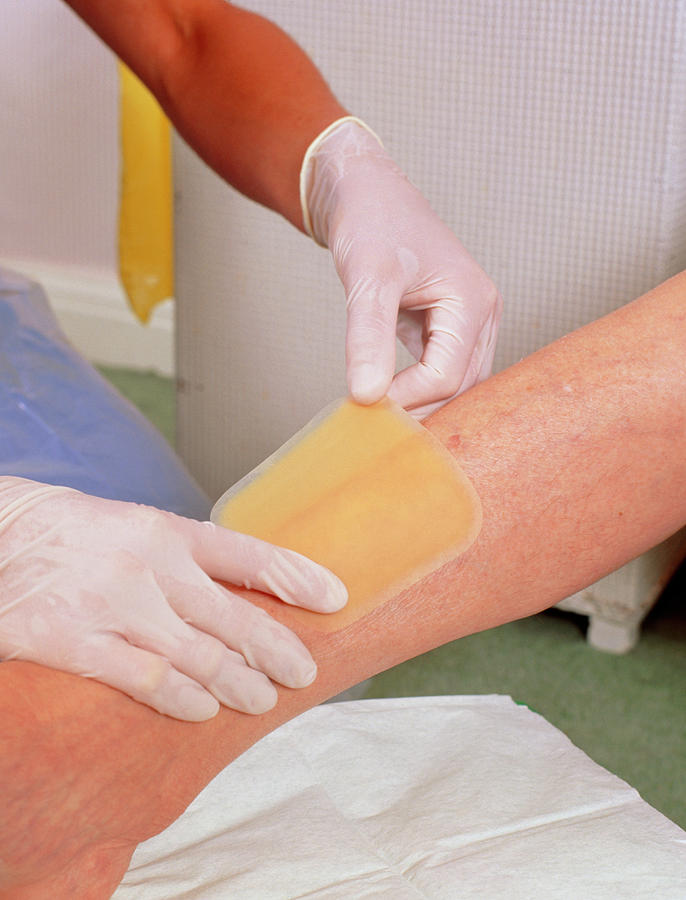 Hydrocolloid Dressing Being Applied To Leg by Chris Priest / Science Photo  Library