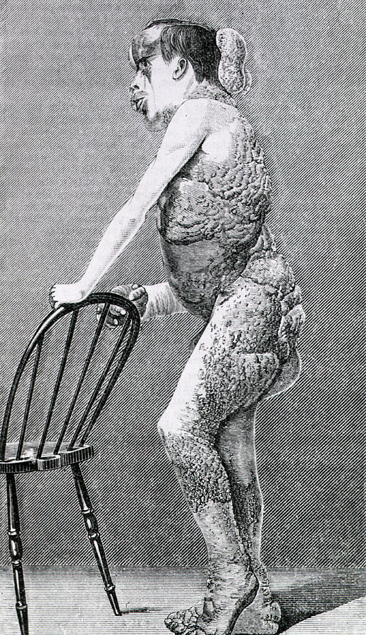 Joseph Merrick by Us National Library Of Medicine / Science Photo