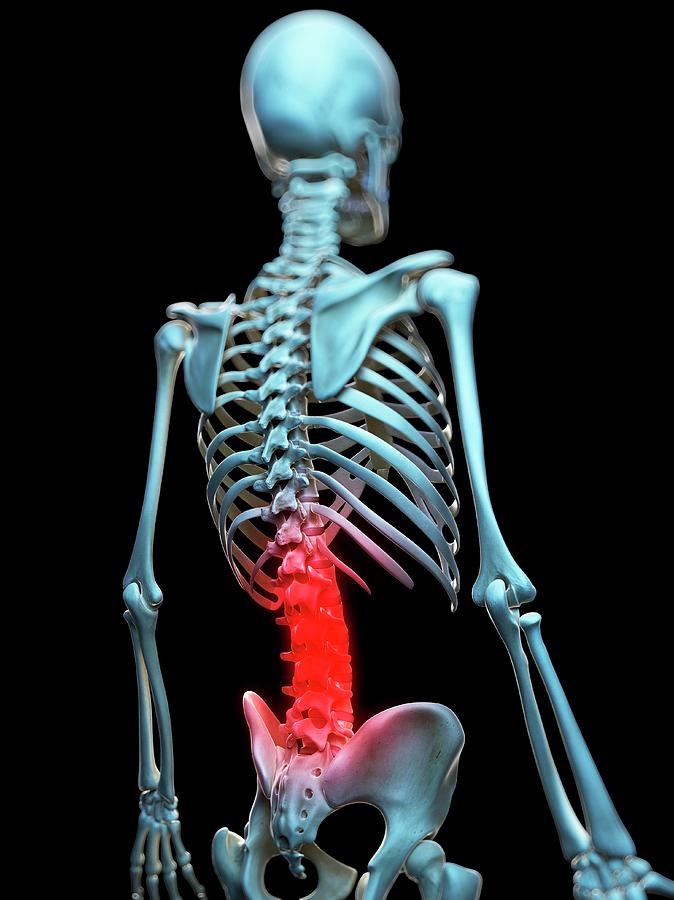 Painful Back by 3Dmedisphere / Science Photo Library