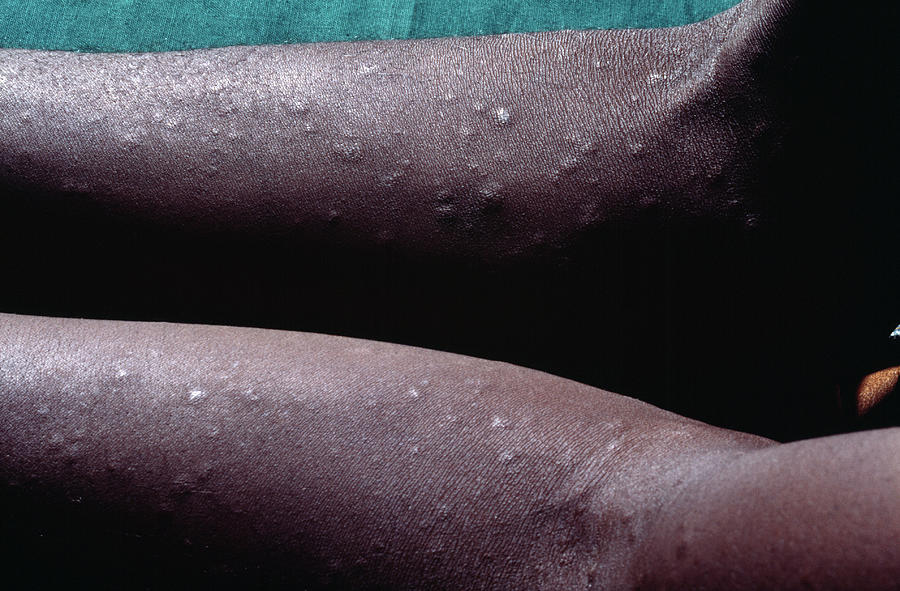 Sphlis Rahs Syphilis Rash In An Aids Patient by Science Photo Library