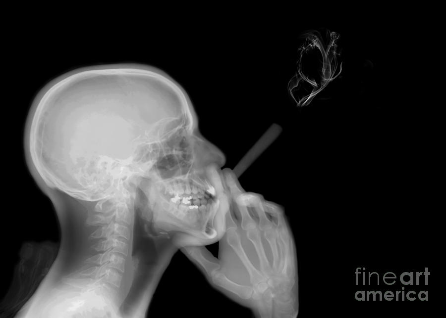X-ray Of A Man Smoking A Cigarette by Photostock-Israel / Science Photo  Library