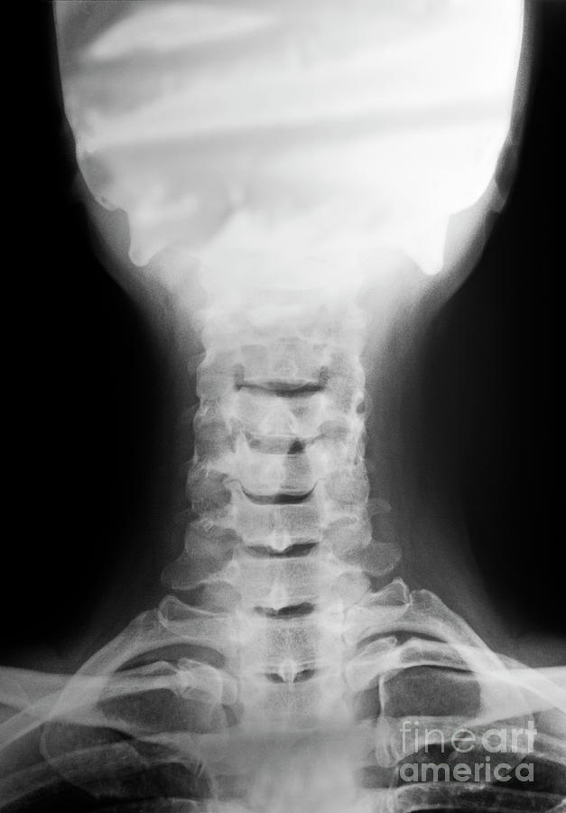 Cervical vertebra and head X-ray #1 Photograph by Sami Sarkis Photography