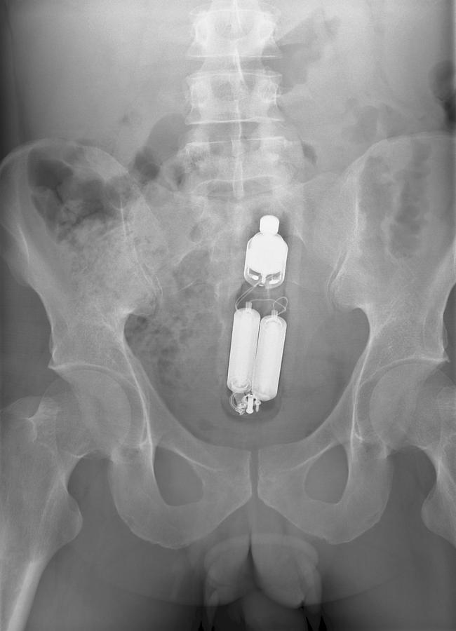 Sex Toy In Man's Rectum, X-ray #2 by Du Cane Medical Imaging Ltd / Science  Photo Library