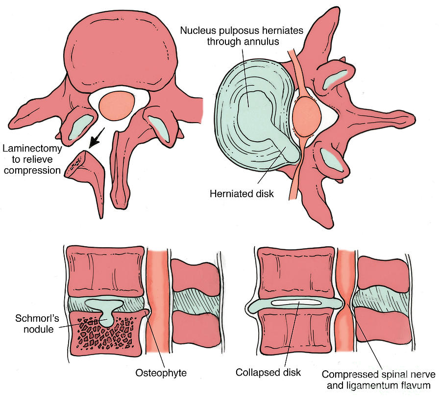 Rare Spinal Disc Illustration Of Spinal Disk Pathologies #8 by Science Source