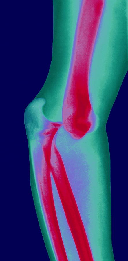 Displaced Elbow Dislocated Elbow Joint, X-ray by