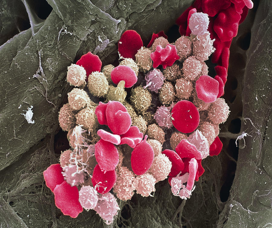 Leukaemia Blood Cells, Sem by Steve Gschmeissner / Science Photo Library