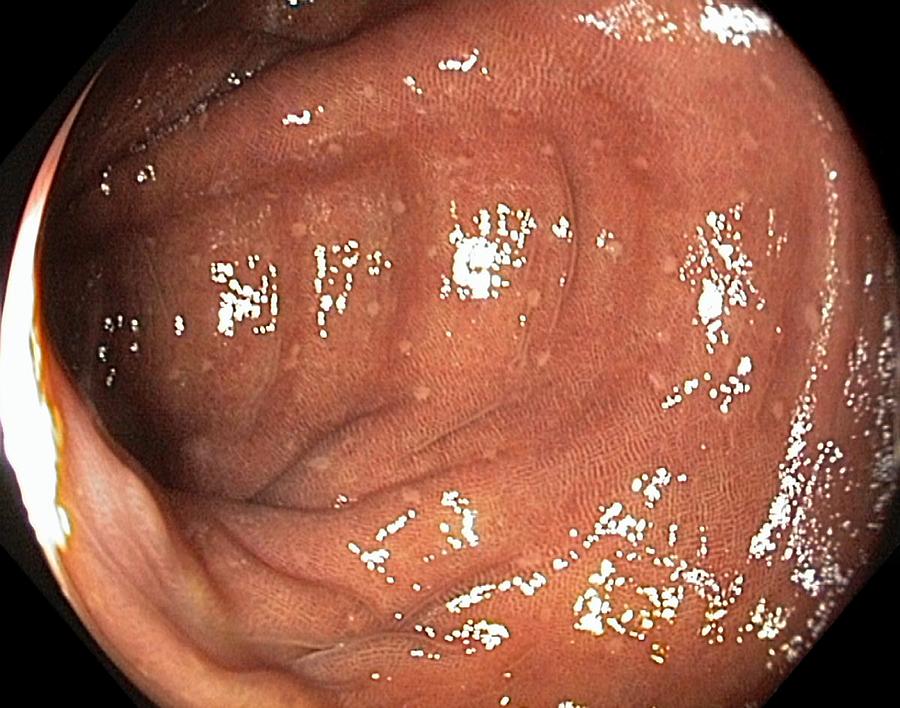 melanotic mucosa in colon Pigmentation (melanosis) Of The Colon by Gastrolab / Science Photo Library