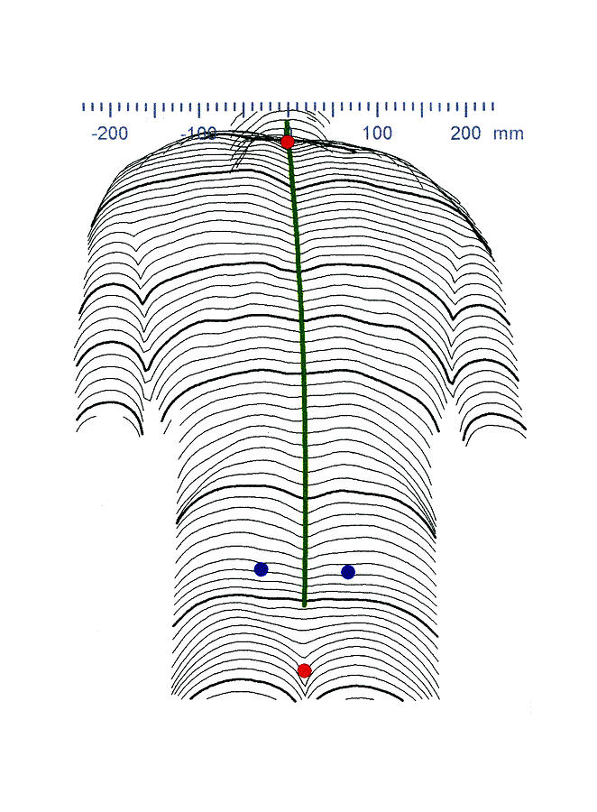 Scoliosis Of The Back, Contour Map by Alfred Pasieka / Science Photo ...