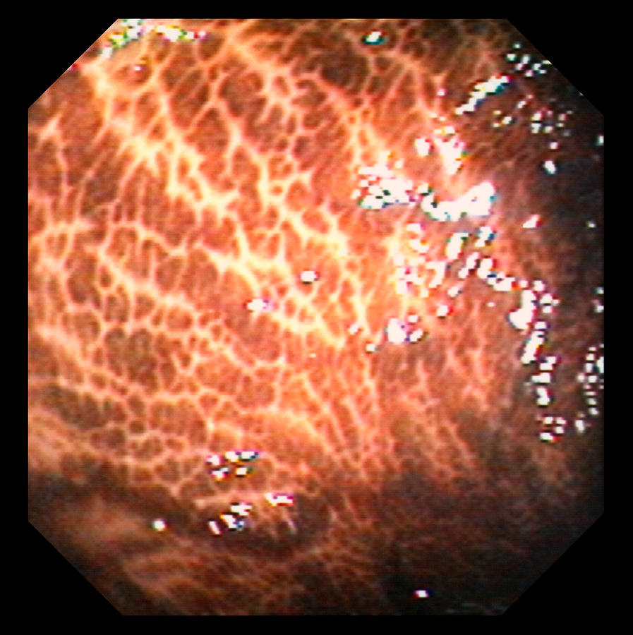 melanotic mucosa in the entire colon Experimental and Therapeutic Medicine main image 1