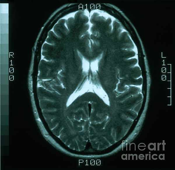Mri Of Normal Brain #1 Tapestry by Science Source - Science Source Prints