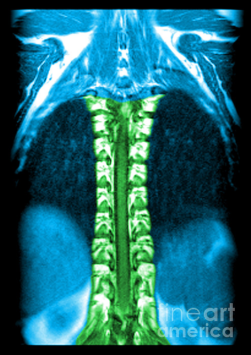 Mri Of Normal Thoracic Spinal Cord #2 Greeting Card by Medical Body Scans