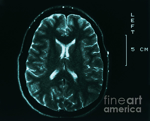 Mri Of Normal Brain #25 Tapestry by Science Source - Science Source Prints