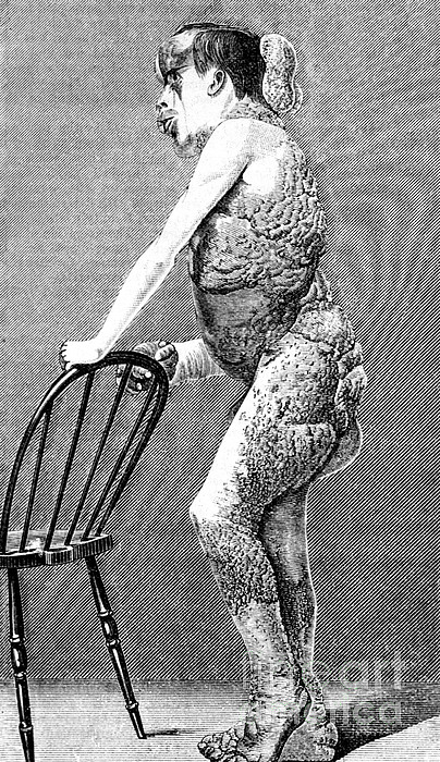 Joseph Merrick, The Elephant Man #3 Jigsaw Puzzle by Science