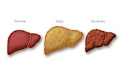 Liver Disease Progression, Illustration Weekender Tote Bag by Monica ...