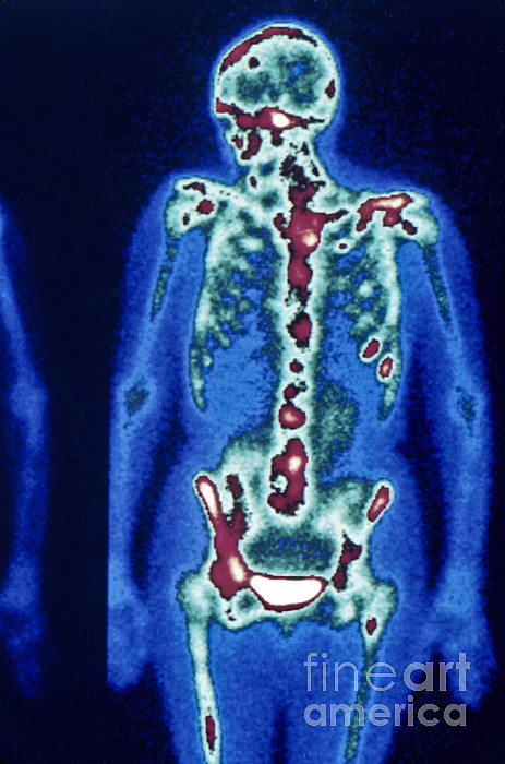 Bone Scan Showing Cancerous Lesions Greeting Card by Inga Spence