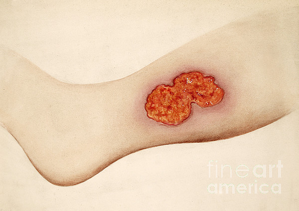 Tibia Ulcer Gouty Ulcer, Left Tibia, Inner Side Greeting Card by Wellcome Images