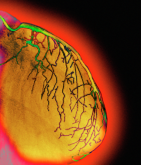 Coloured Angiogram Of Coronary Arteries Of Heart Greeting Card by ...