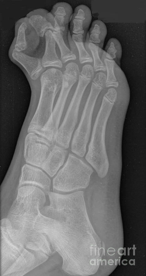 Extra Toe #1 by Rajaaisya / Science Photo Library