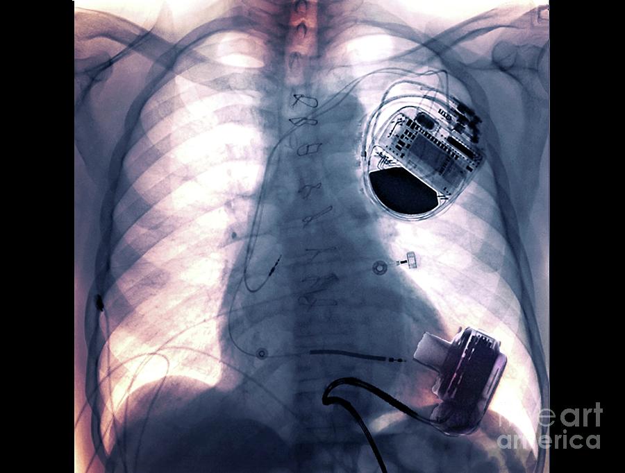 Pacemaker And Heart Pump #1 by Zephyr / Science Photo Library