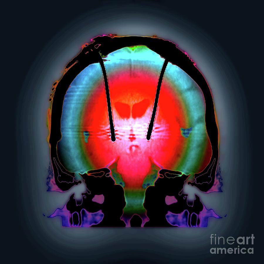 Parkinson's Brain Pacemaker #1 by Zephyr / Science Photo Library