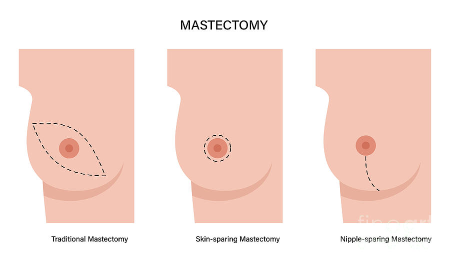 Masterctomy Types Types Of Female Mastectomy #1 by Pikovit / Science Photo Library