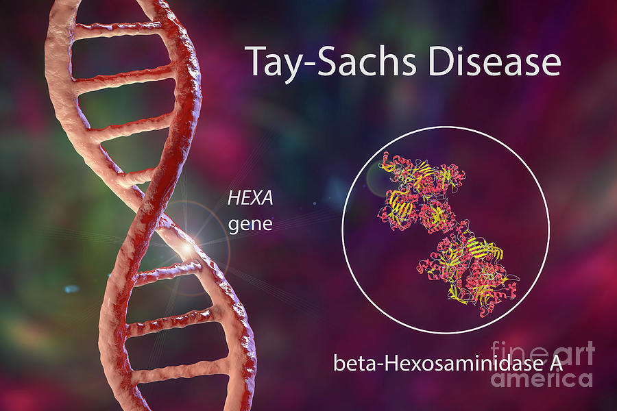 Tay-sachs Disease #14 by Kateryna Kon / Science Photo Library