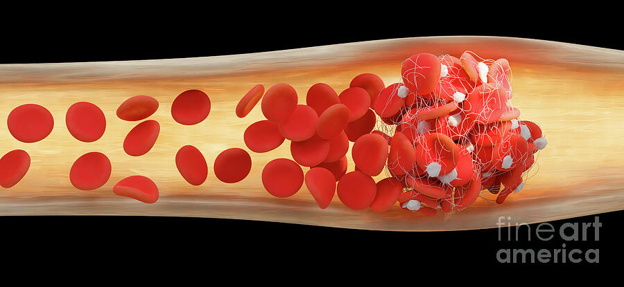 Blood Clot #15 by Tim Vernon / Science Photo Library