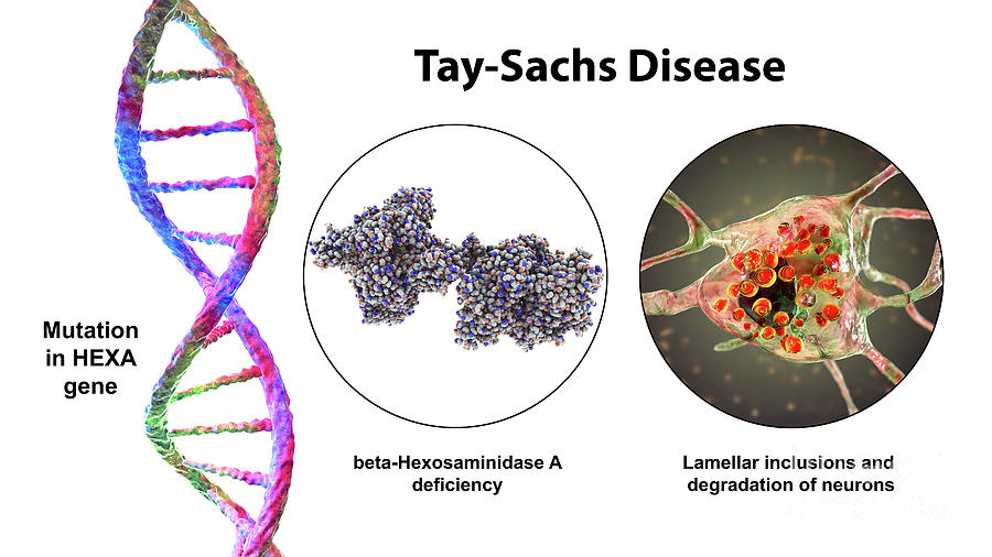 Tay-sachs Disease #20 by Kateryna Kon / Science Photo Library