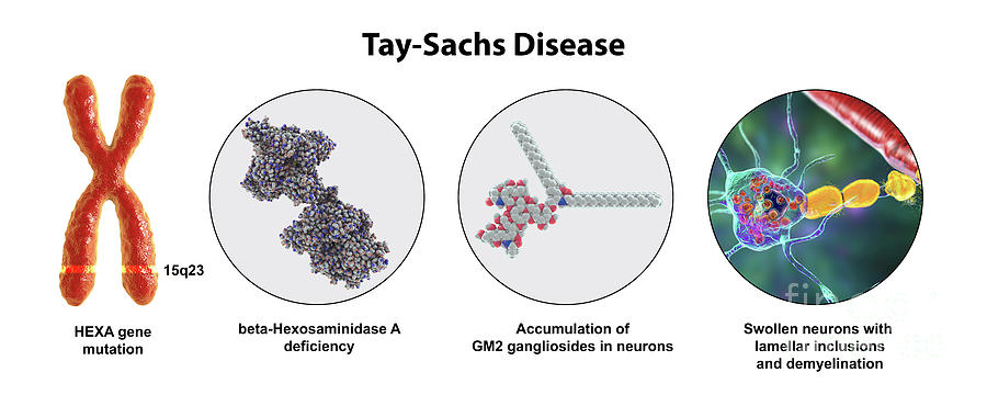 Tay-sachs Disease #23 by Kateryna Kon / Science Photo Library