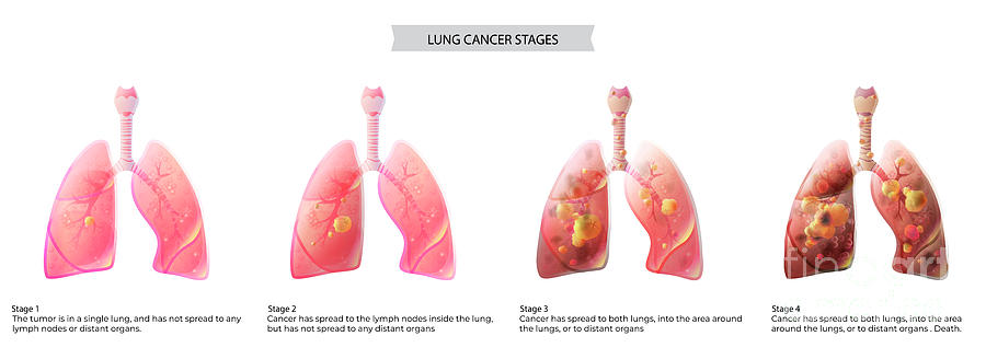 Lungs Cancer #7 by Pikovit / Science Photo Library