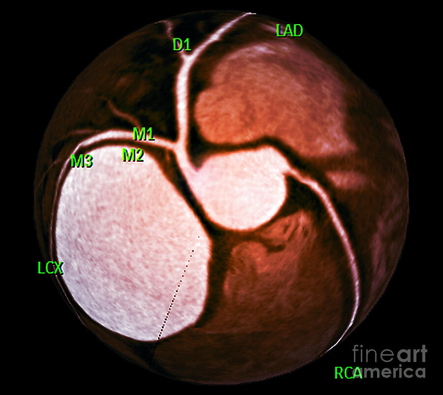 Healthy Coronary Arteries #9 by Zephyr / Science Photo Library