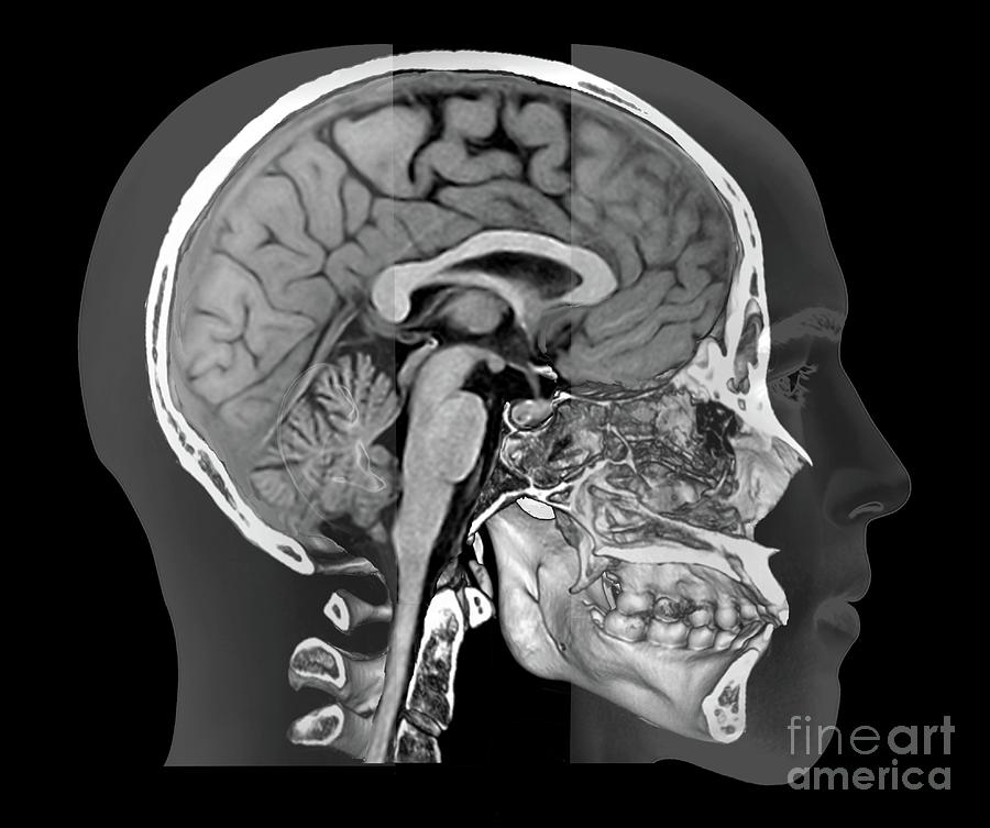 Human Skull And Brain #9 by Zephyr / Science Photo Library