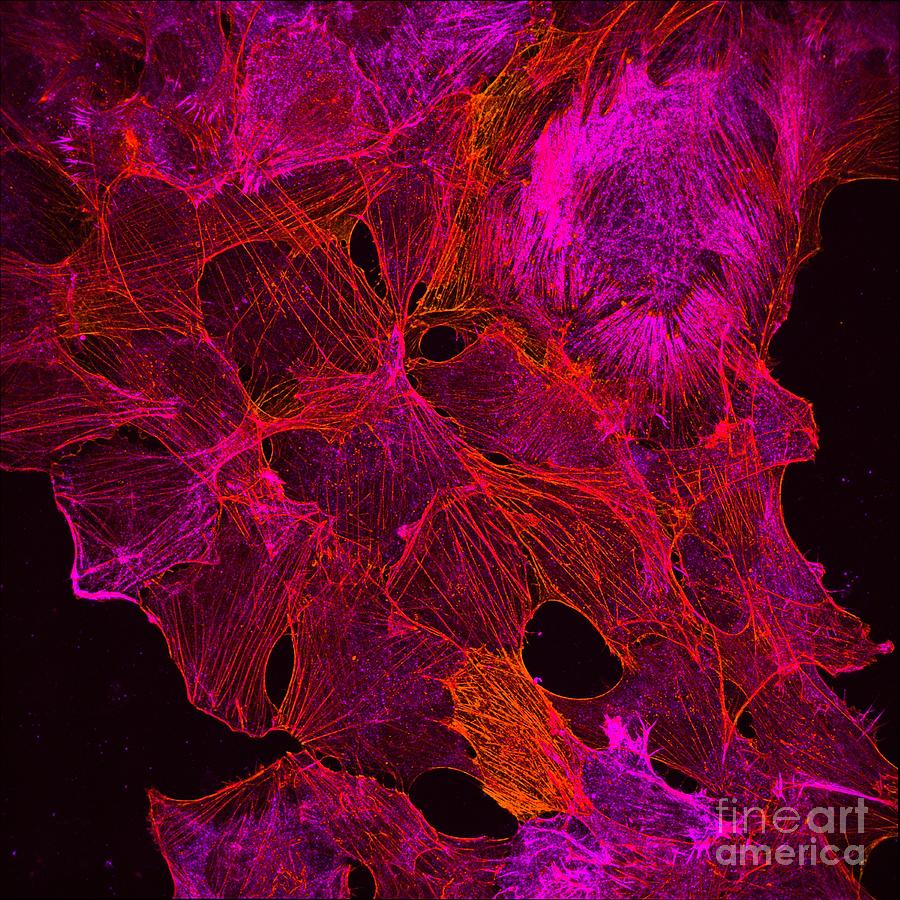 Cancer Cells Showing Actin Cytoskeleton by "Howard Vindin, The ...