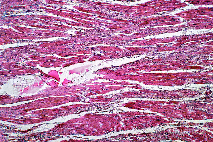 Cardiac Callosity by Choksawatdikorn / Science Photo Library