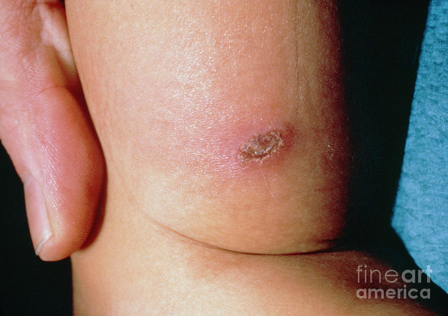 Child Abuse: Wound Caused By Cigarette Burn by Biophoto Associates /  Science Photo Library