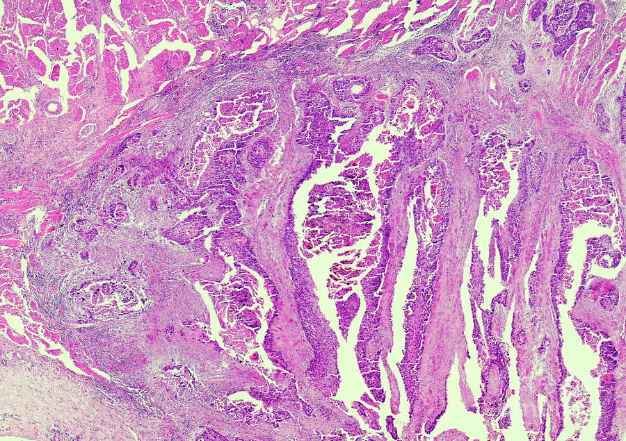 Cornification Process Cornification Of Squamous Cancerous Cells by Nigel Downer / Science ...
