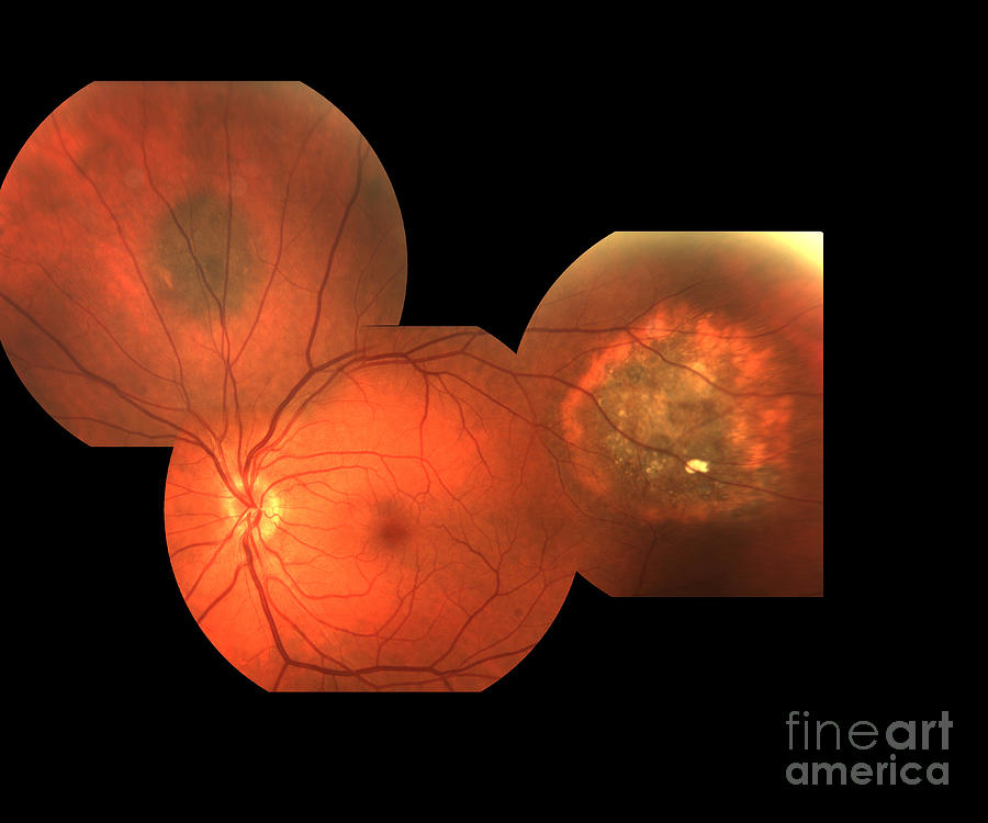 Eye Cancer by Alan Frohlichstein / Science Photo Library