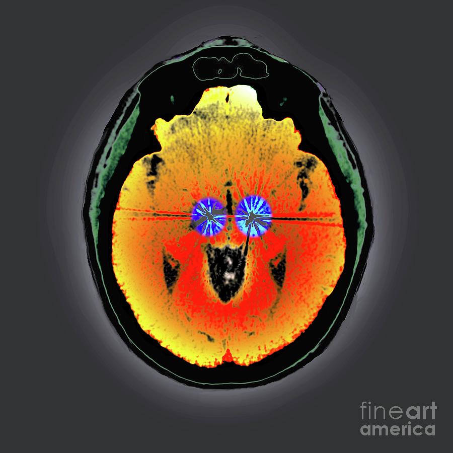 Parkinson's Brain Pacemaker by Zephyr / Science Photo Library