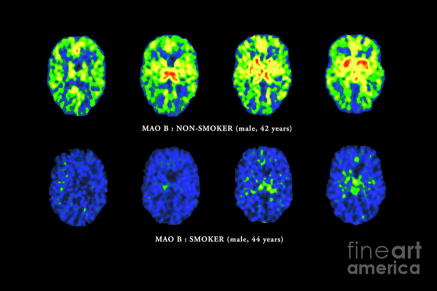 tobacco and the brain Smoking Brain Scans by Pascal Goetgheluck / Science Photo Library